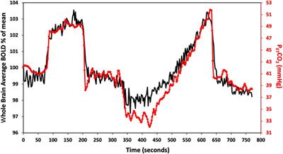 Sickle cell cerebrovascular reactivity to a CO2 stimulus: Too little, too slow